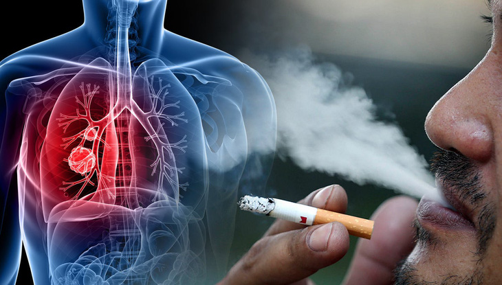 HÚT THUỐC LÁ & PHỔI TẮC NGHẼN MẠN TÍNH (COPD): Khi Hơi Thở Không Còn Là Điều Tự Nhiên